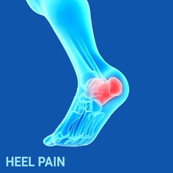 When Stubborn Heel Pain Isn't Plantar Fasciitis - Insoles and Orthotics -  Healthy Step