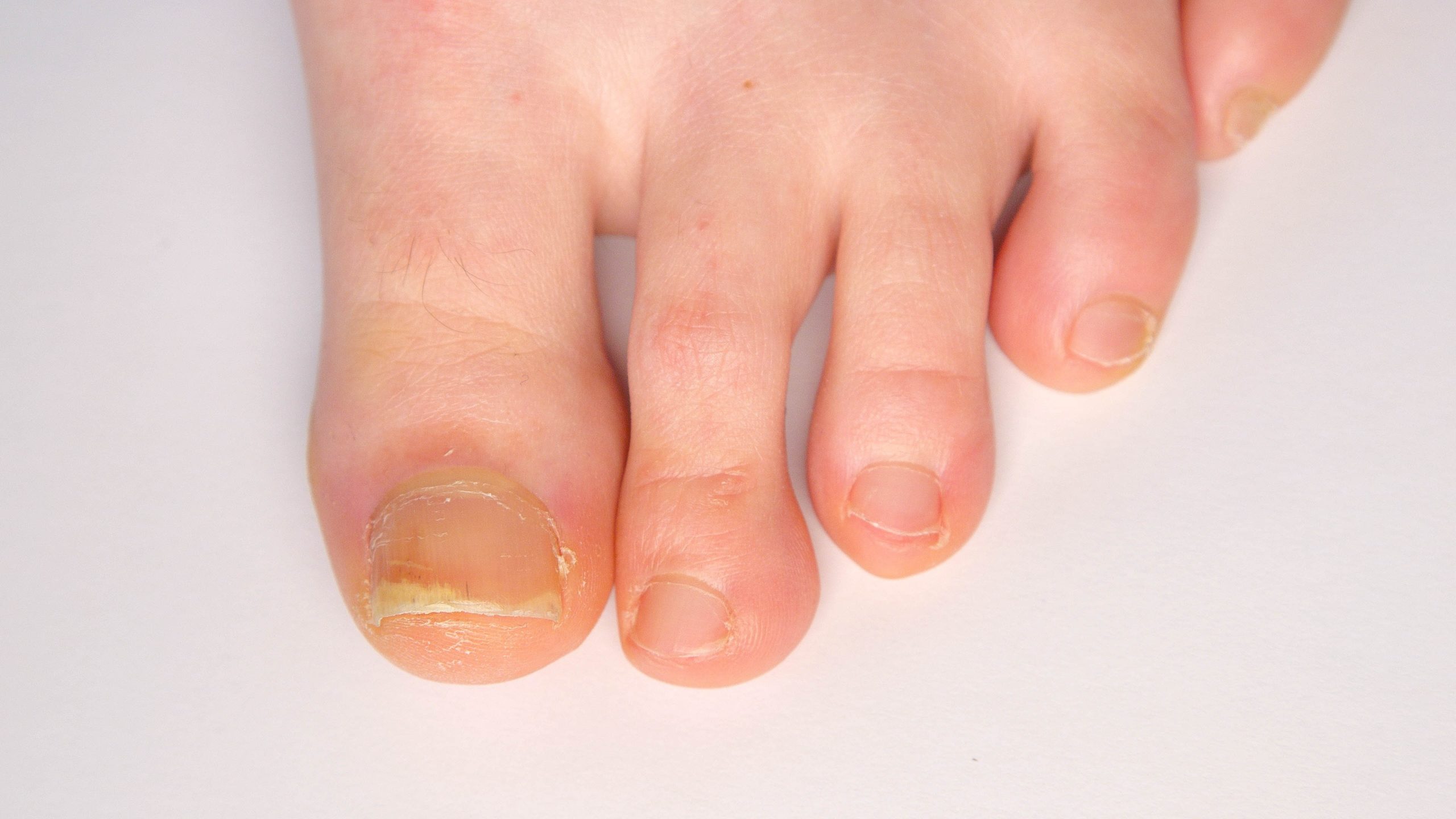 Causes & Symptoms Of Fungal Nail Infection! - By Dr. J.S. Chhabra | Lybrate