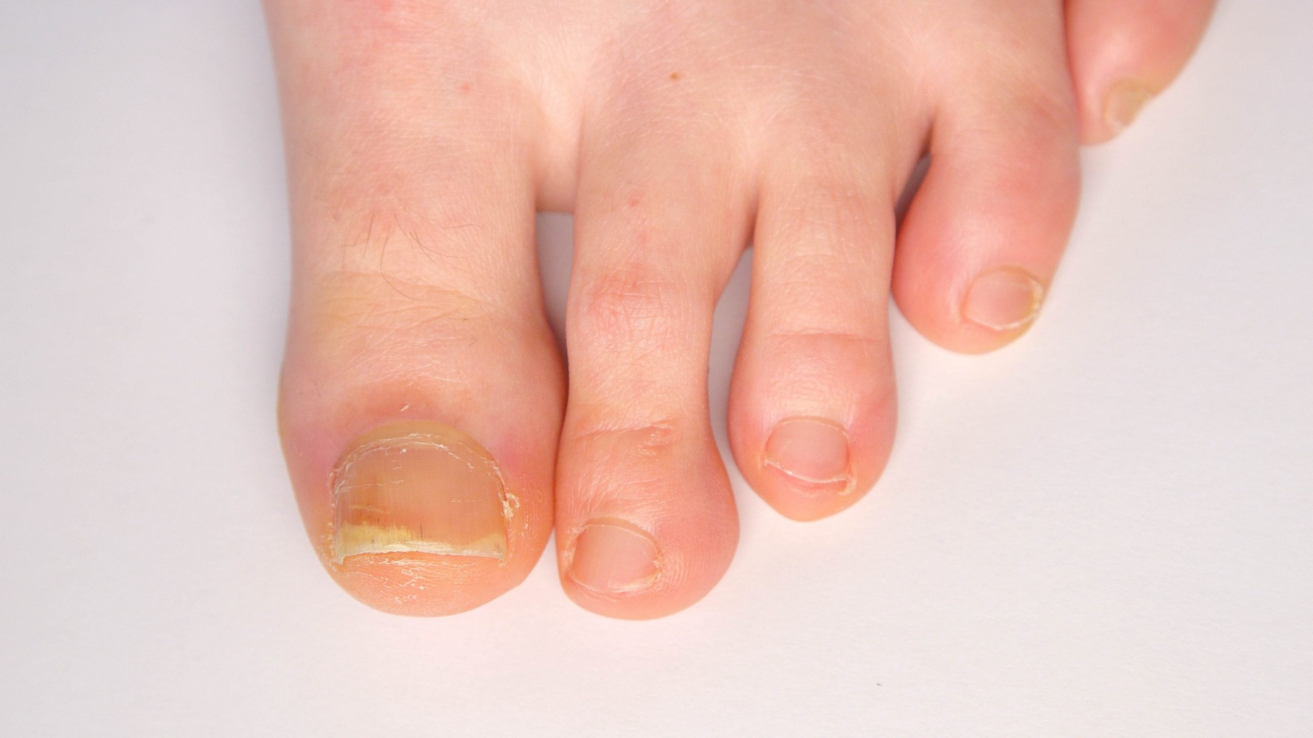 Onychomycosis: Current Trends in Diagnosis and Treatment | AAFP